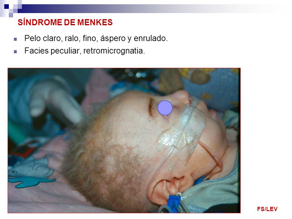 enfermedad de menkes